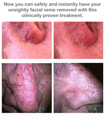 ThermaVein BEfore and After